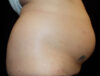 Coolsculpting case #4338