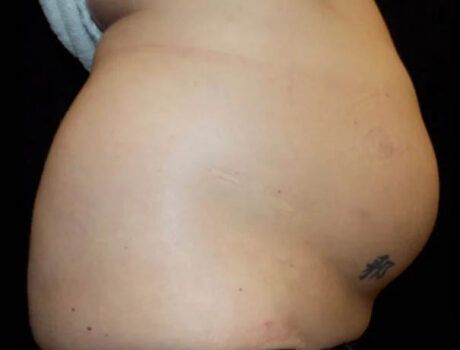 Coolsculpting case #4338