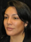 Buccal Fat Removal case #4152