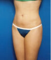 Liposuction case #4706