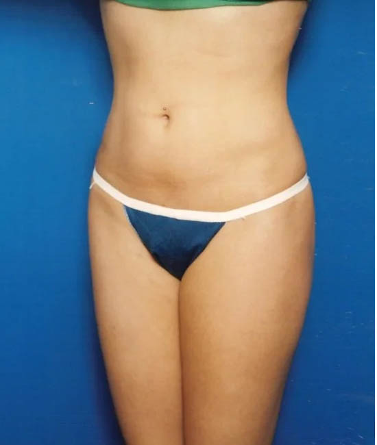 Liposuction case #4706