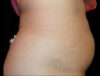 Coolsculpting case #4338