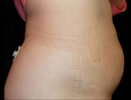 Coolsculpting case #4338