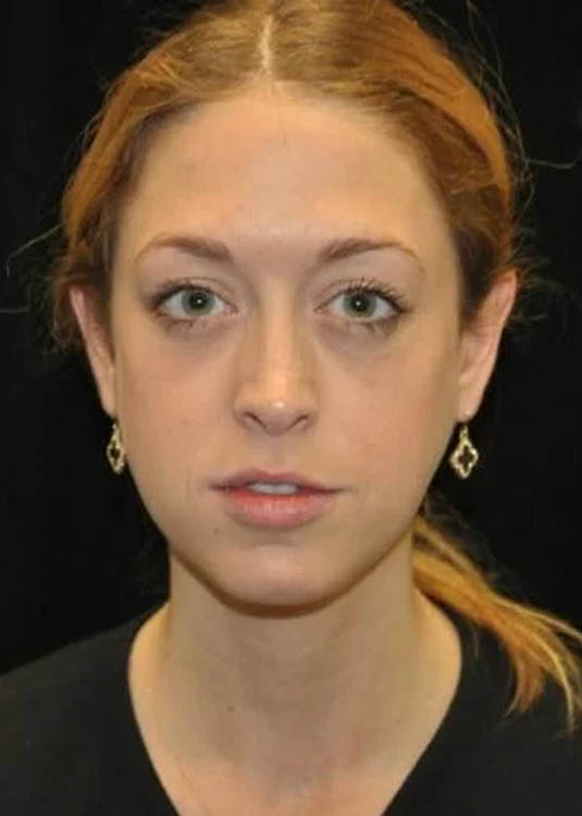_0042_case-14-8-chin-augmentation-view-1-1.webp