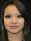 Buccal Fat Removal case #4155