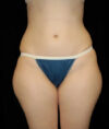 Liposuction case #4713