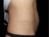 Coolsculpting case #4345