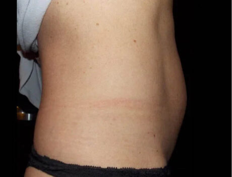Coolsculpting case #4345