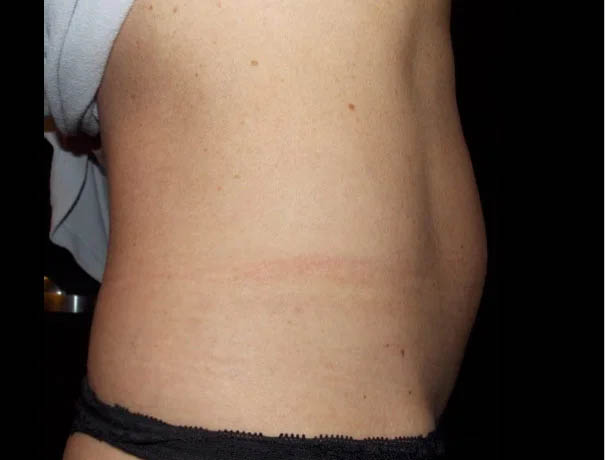 Coolsculpting case #4345