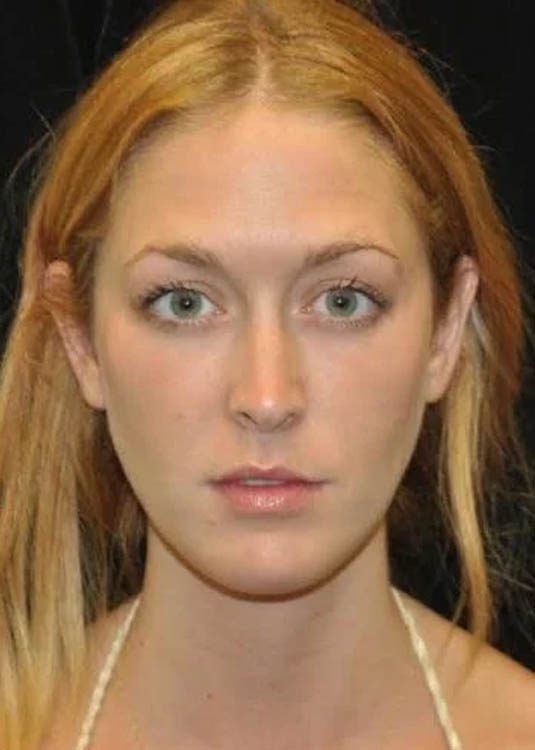 _0043_case-14-8-chin-augmentation-view-1-2.webp