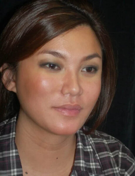 Neck Liposuction case #4976