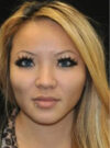 Buccal Fat Removal case #4155