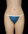 Liposuction case #4713