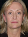 Facial Fat Grafting case #4542