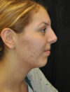 Neck Liposuction case #4981