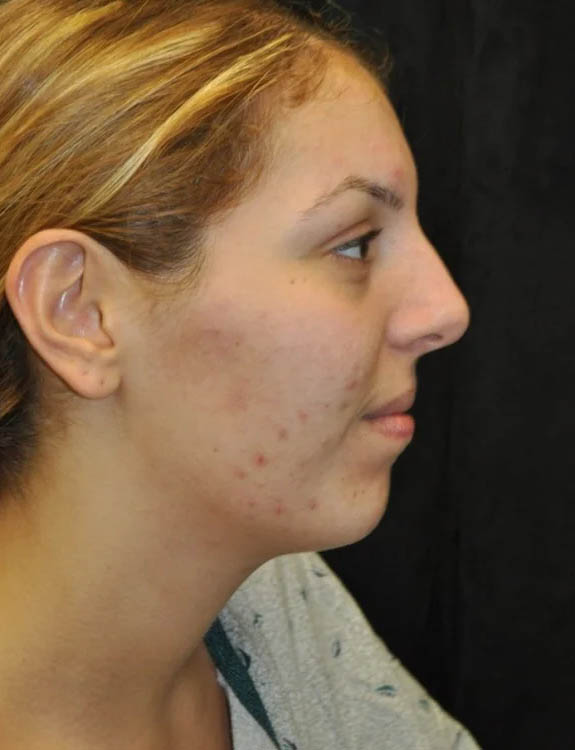 Neck Liposuction case #4981