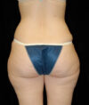 Liposuction case #4713