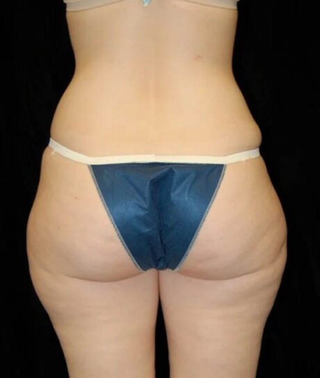 Liposuction case #4713