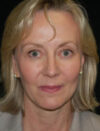 Facial Fat Grafting case #4542