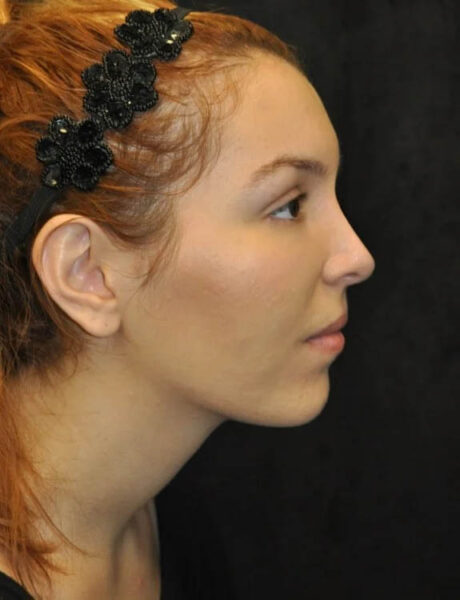 Neck Liposuction case #4981