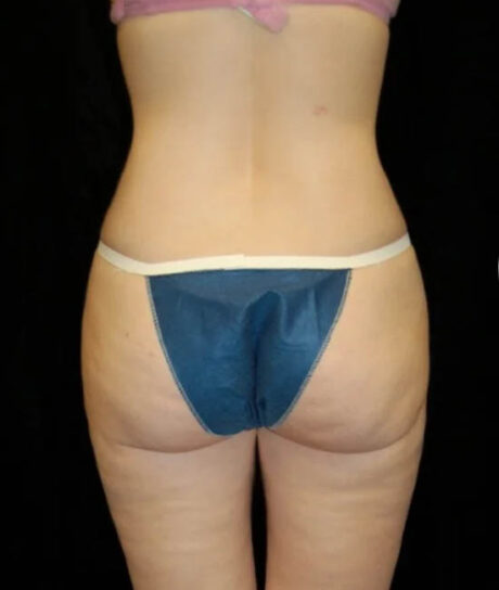 Liposuction case #4713