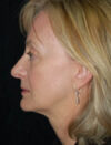 Facial Fat Grafting case #4542