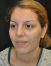 Neck Liposuction case #4981