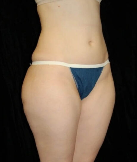 Liposuction case #4713