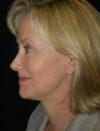 Facial Fat Grafting case #4542