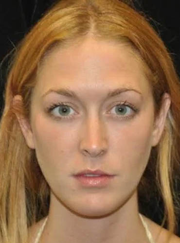 Buccal Fat Removal case #4161