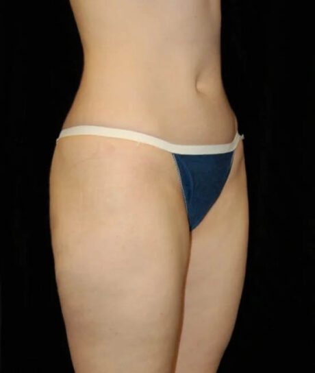 Liposuction case #4713