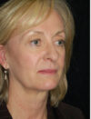 Facial Fat Grafting case #4542