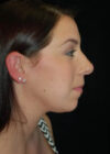 Chin Implant case #4224