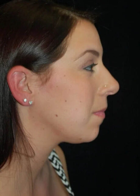 Chin Implant case #4224