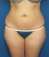 Liposuction case #4720