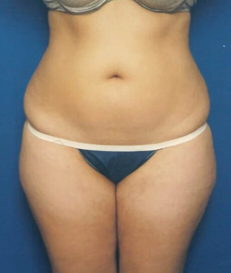 Liposuction case #4720