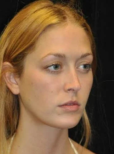 Buccal Fat Removal case #4161