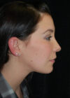 Chin Implant case #4224