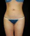 Liposuction case #4720