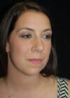 Chin Implant case #4224