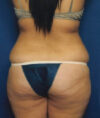 Liposuction case #4720