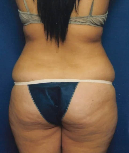 Liposuction case #4720