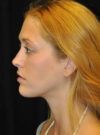 Buccal Fat Removal case #4161