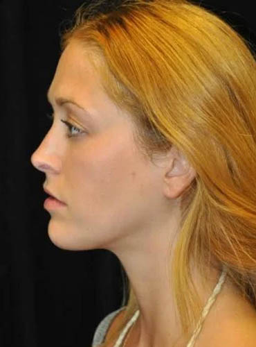Buccal Fat Removal case #4161