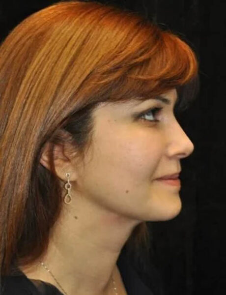 Neck Liposuction case #4917