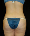Liposuction case #4720