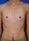 Breast Augmentation case #3680