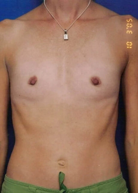Breast Augmentation case #3680