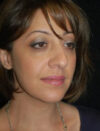 Facial Fat Grafting case #4549
