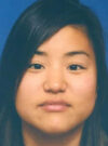 Buccal Fat Removal case #4168